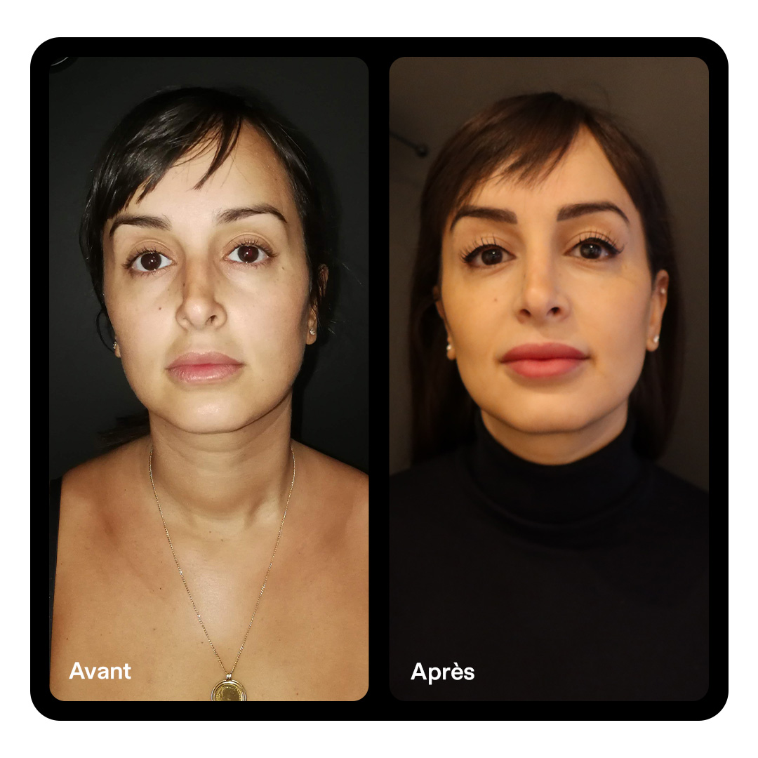 Rhinoplastie Clinique Paris Étoile 05