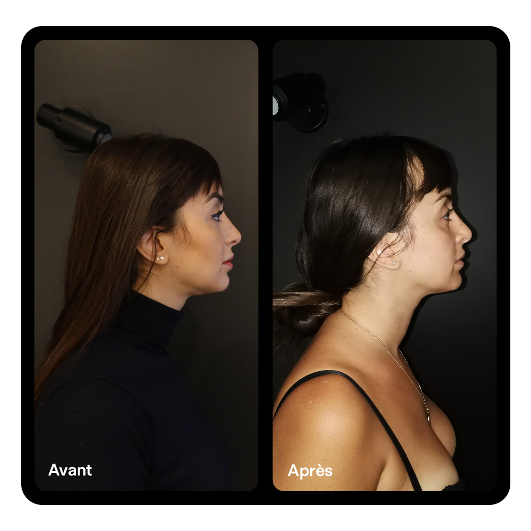 Rhinoplastie Clinique Paris Étoile 06