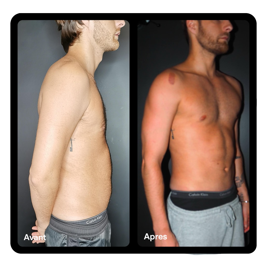 Liposculture Abdominale Clinique Paris Étoile 03