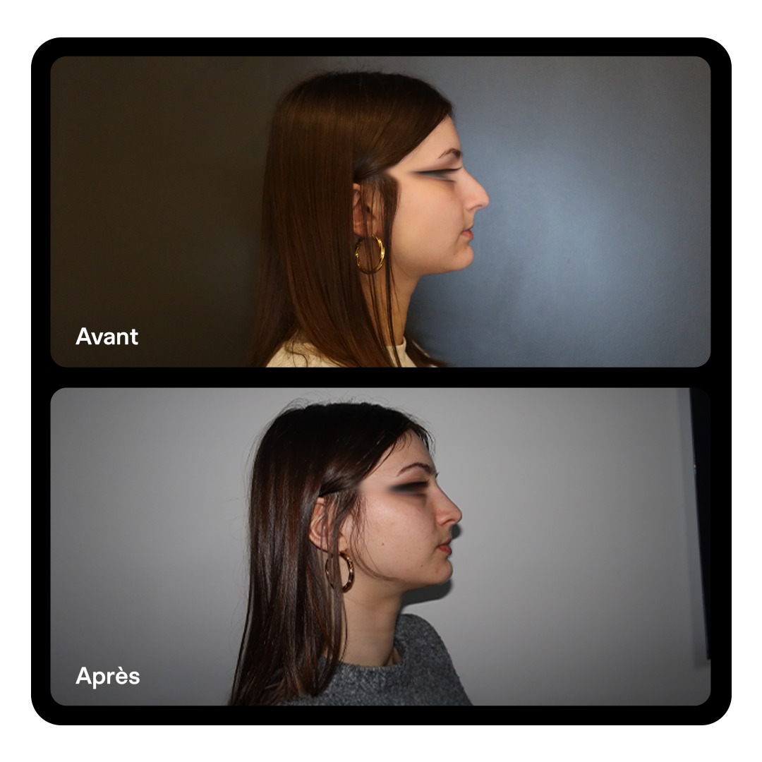 Rhinoplastie Clinique Paris Étoile 03