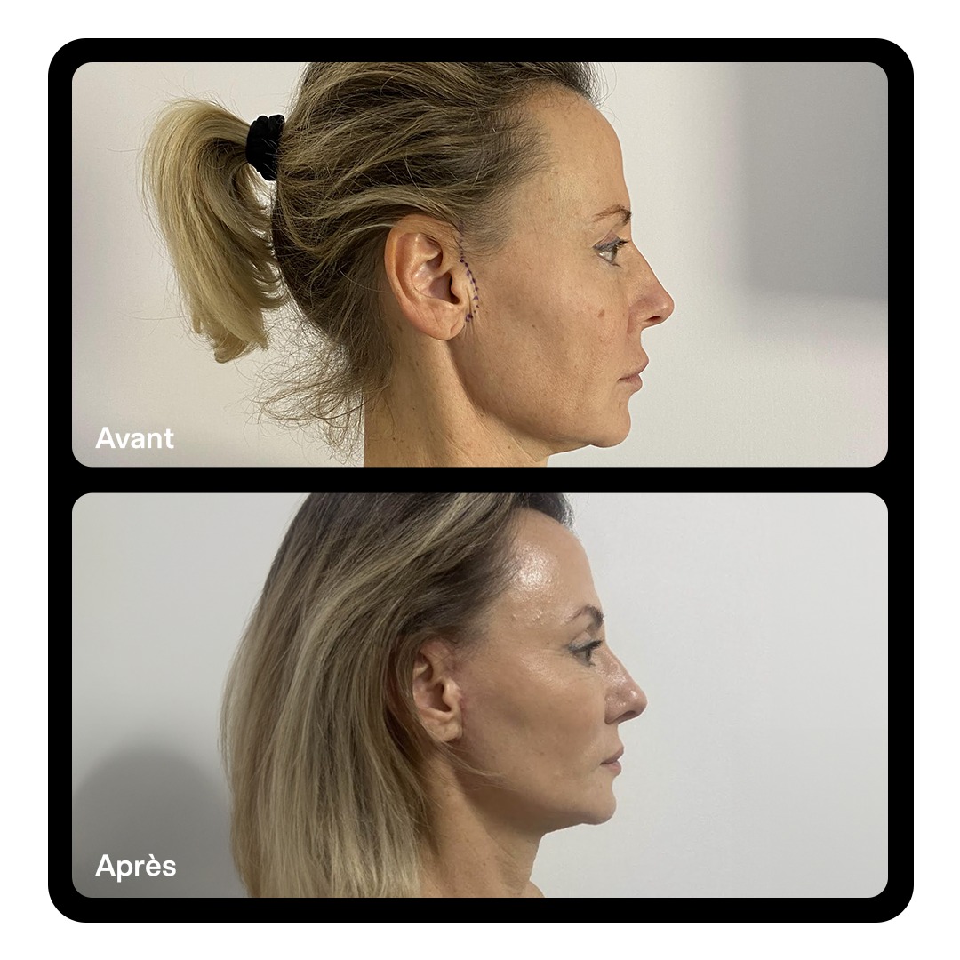 Lifting facial Clinique Paris Étoile 02