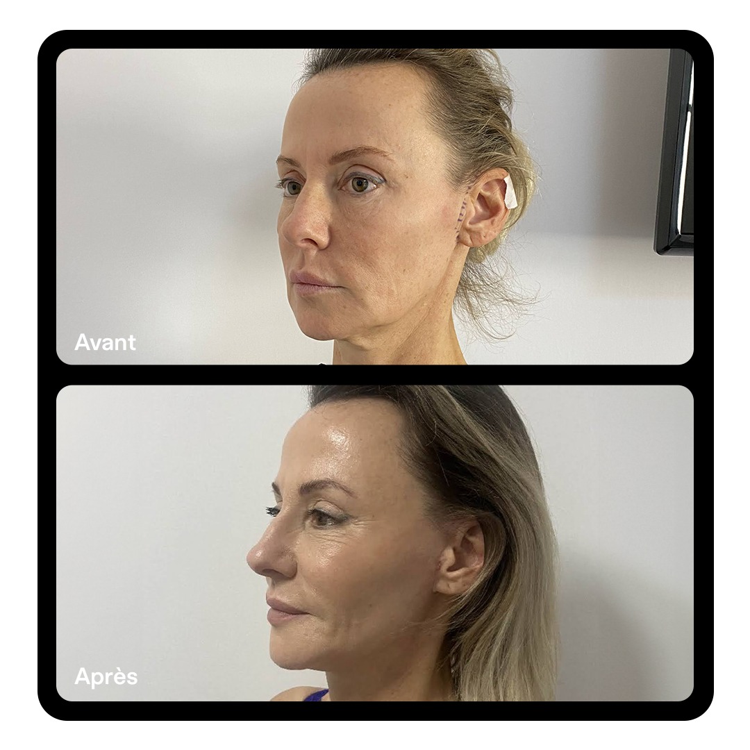 Lifting facial Clinique Paris Étoile 03