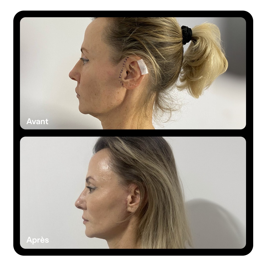 Lifting facial Clinique Paris Étoile 05