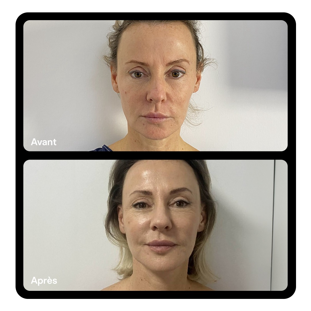 Lifting facial Clinique Paris Étoile 01