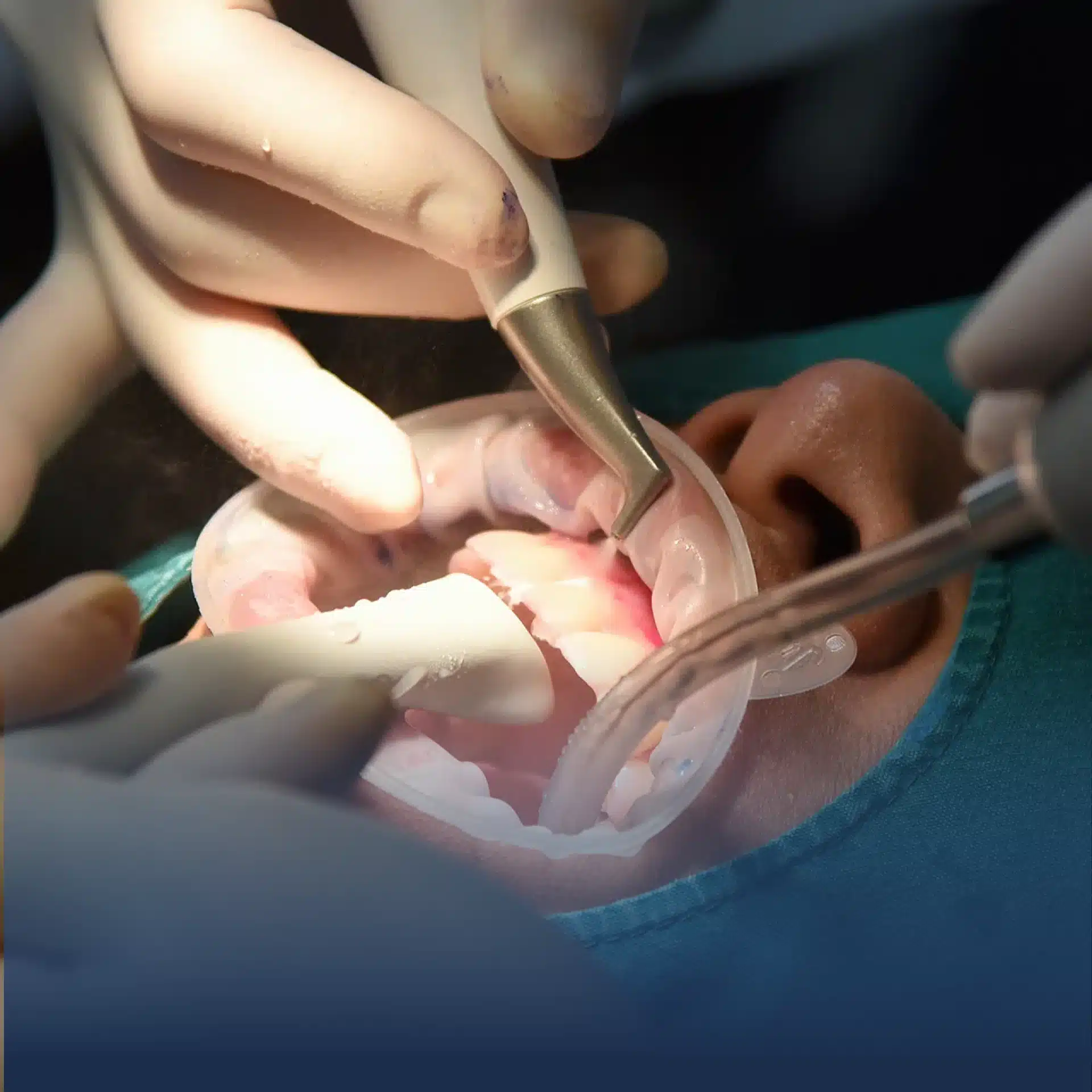 clinique-esthetique-paris-etoile-chirurgie-de-dents